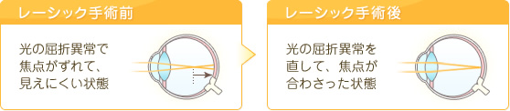 レーシック手術前 光の屈折異常で焦点がずれて、見えにくい状態 レーシック手術後 光の屈折異常を直して、焦点が合わさった状態
