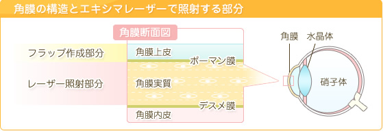 角膜の構造とエキシマレーザーで照射する部分 角膜断面図 フラップ作成部分 レーザー照射部分 角膜上皮 ポーマン膜 角膜実質 デスメ膜 角膜内皮 角膜 水晶体 硝子体